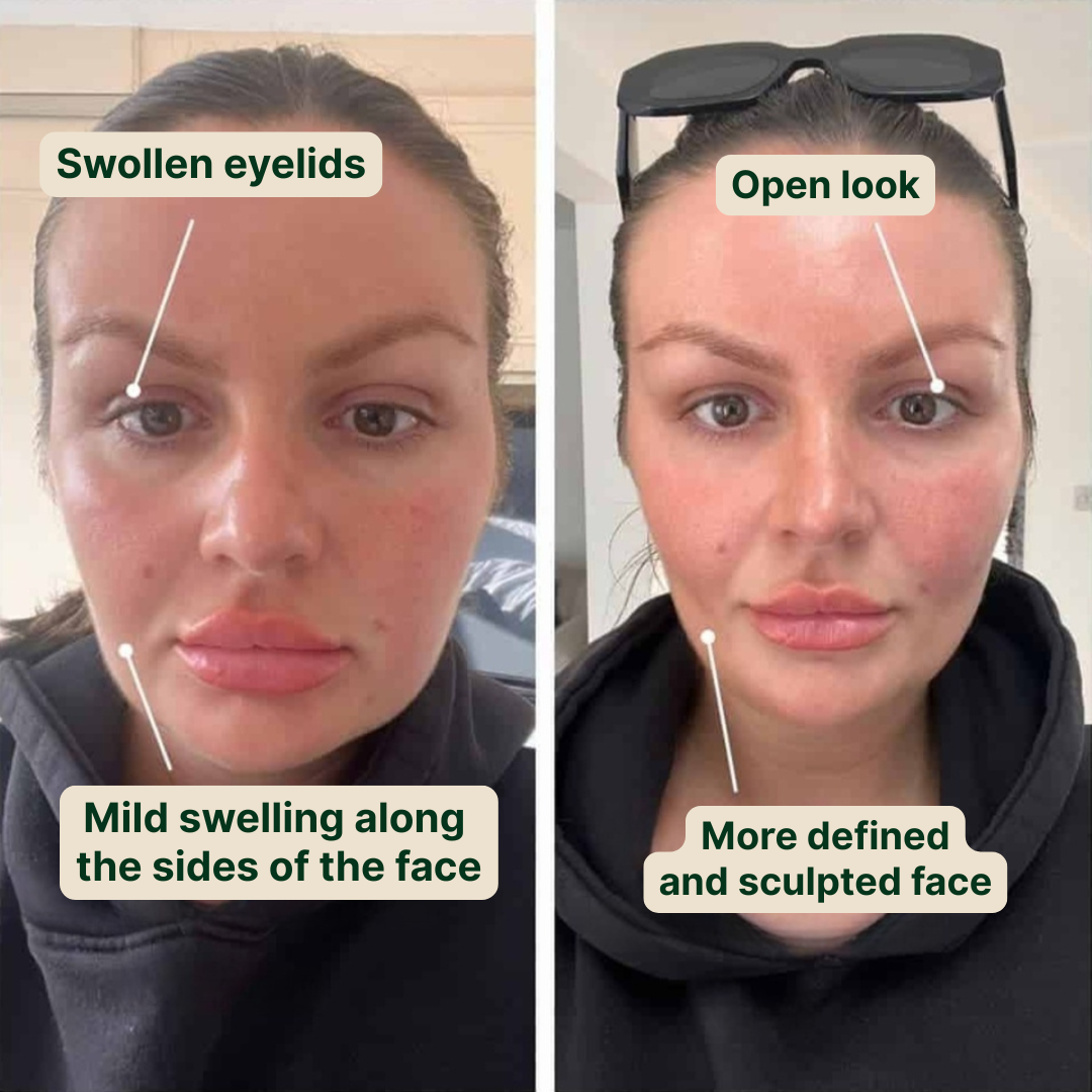 Debloater Lymphatic Drainage